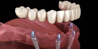 Dental Implants In Parramatta: The Revolutionary Solution For A Perfect Smile