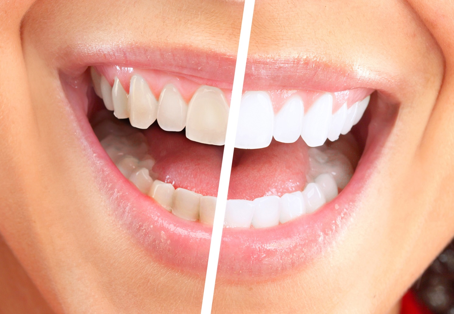 teeth whitening fitzroy