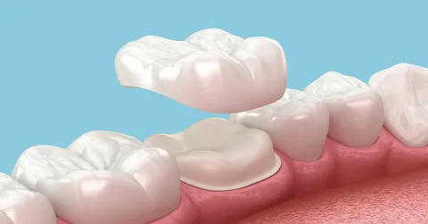 Dental Crowns Epping – Restore Strength, Function, and Confidence to Your Smile