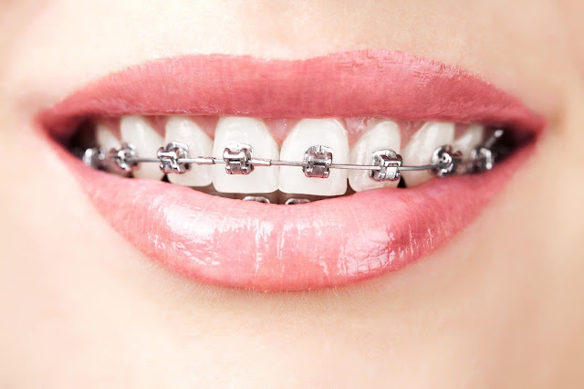 Types Of Orthodontic Treatments