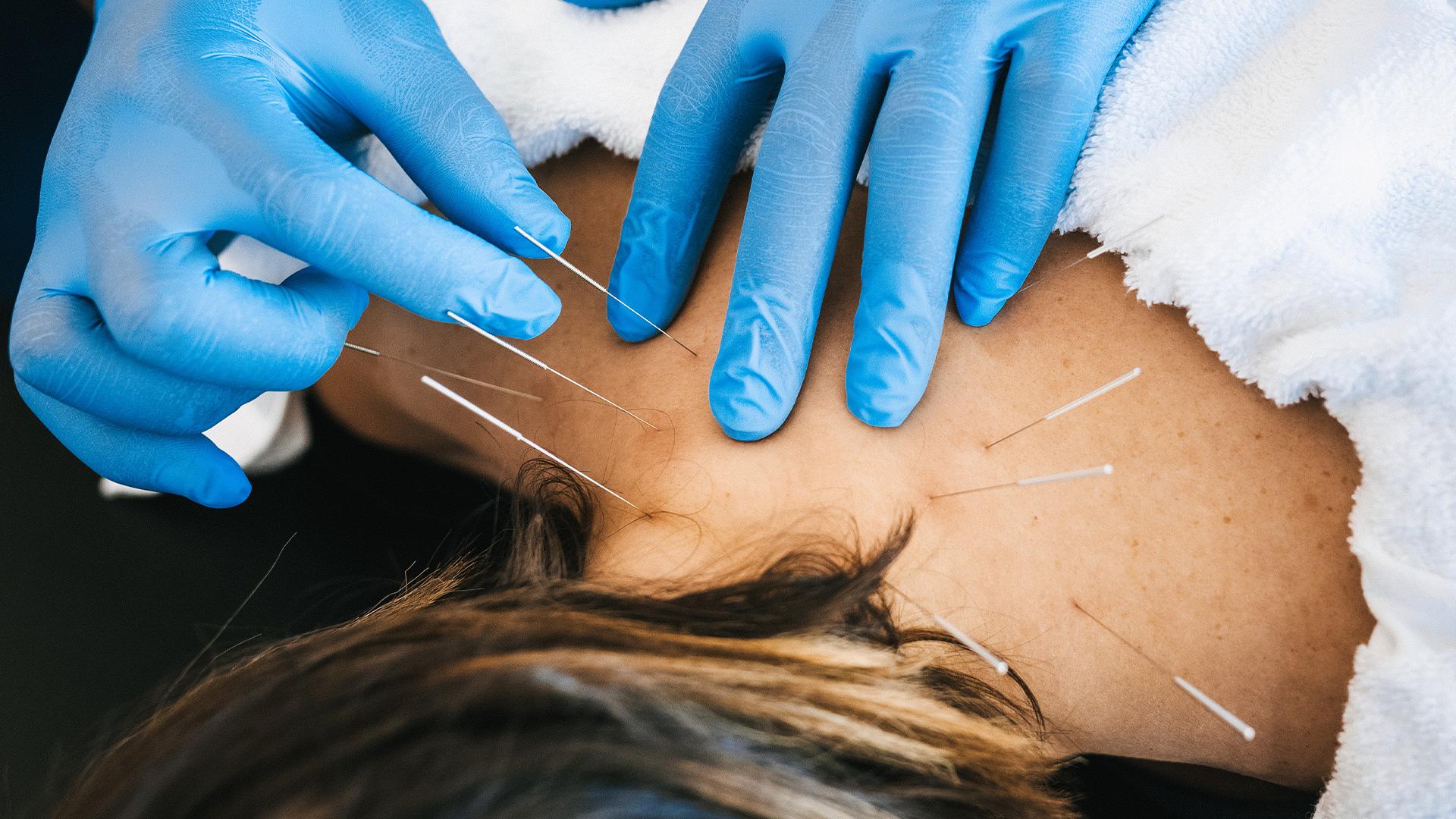 Dry Acupuncture: Understanding This Targeted Approach to Muscle Care